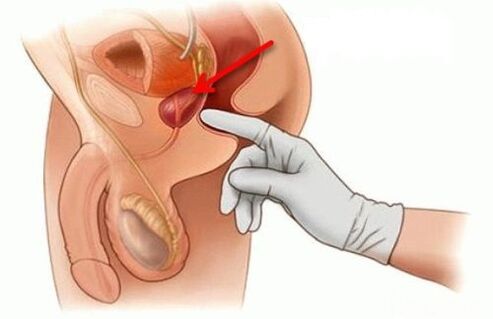 massage de la prostate pour la prostatite