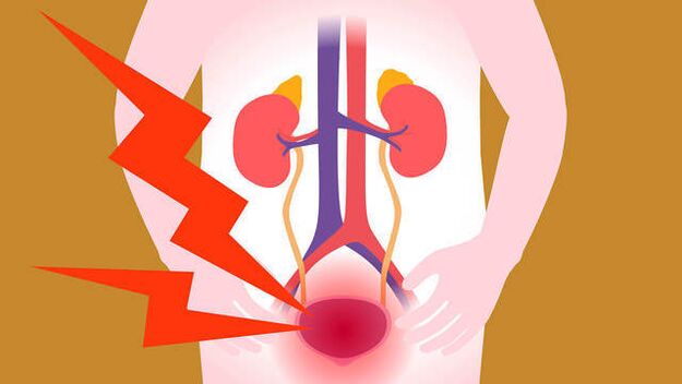 douleur dans la région de la vessie avec prostatite aiguë