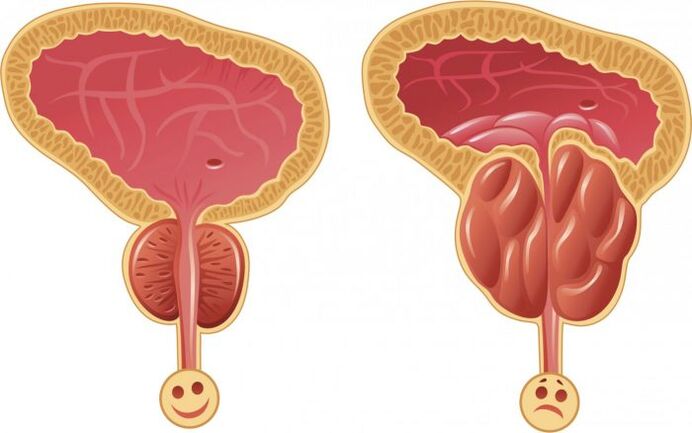 prostate saine et enflammée avec prostatite